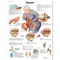 Медицинский плакат Артрит