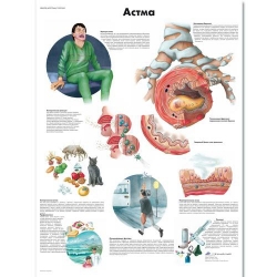 Медицинский плакат Астма