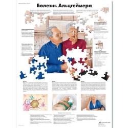 Медицинский плакат Болезнь Альцгеймера