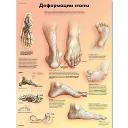 Медицинский плакат Деформация стопы
