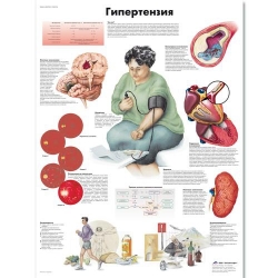 Медицинский плакат Гипертензия