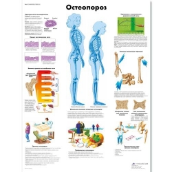 Медицинский плакат Остеопороз