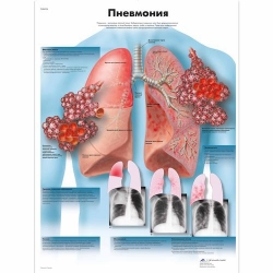 Медицинский плакат Пневмония