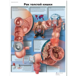 Медицинский плакат Рак толстой кишки