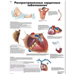 Медицинский плакат Распространенные сердечные заболевания