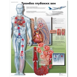 Медицинский плакат Тромбоз глубоких вен
