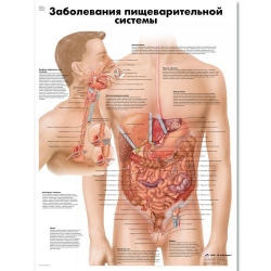 Медицинский плакат Заболевания пищеварительной системы