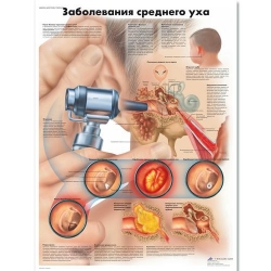 Медицинский плакат Заболевания среднего уха