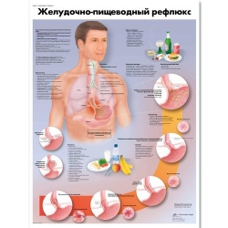 Медицинский плакат Желудочно-пищевой рефлюкс