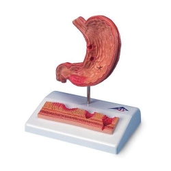 Модель желудка с язвами, 2 части