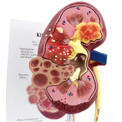 Модель почки человека с патологиями UL