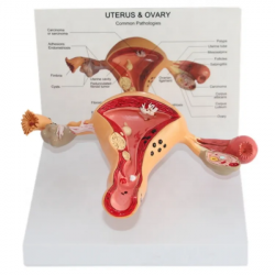 Анатомическая матка человека, модель патологических изменений репродуктивной системы UL-04