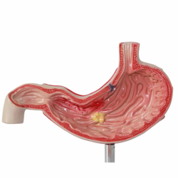 Анатомическая модель Модель специального сечения хронического патологического гастрита и язвенной болезни желудка для лечебно-пи