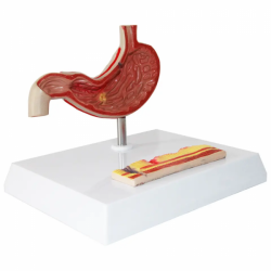 Анатомическая модель Модель специального сечения хронического патологического гастрита и язвенной болезни желудка для лечебно-пи