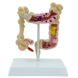 Патологическая модель толстой кишки человека UL