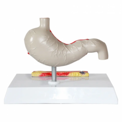Модель специального сечения хронического патологического гастрита и язвенной болезни желудка  UL-CC