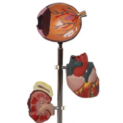 Анатомическая модель человеческого диабетического органа Миниатюрные модели глаз, сердца, почек, артерий и стопы UL-326-1