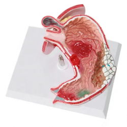 Анатомическая модель больного желудка человека   UL-326-1