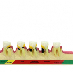 Модель пародонтоза UL