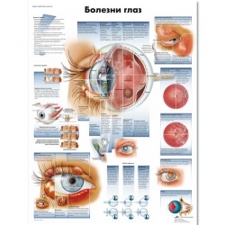 Медицинский плакат Болезни глаз