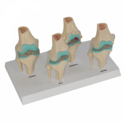Модель заболевания коленного сустава в натуральную величину, 4 этапа UL-190104-1