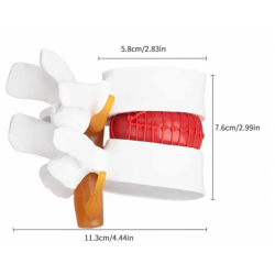 Анатомическая модель межпозвоночного диска с грыжей UL