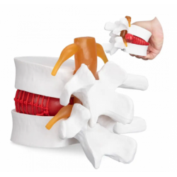 Анатомическая модель межпозвоночного диска с грыжей UL