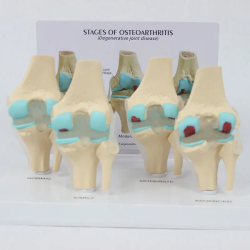 Модель заболевания коленного сустава в натуральную величину 4-этапная UL-K