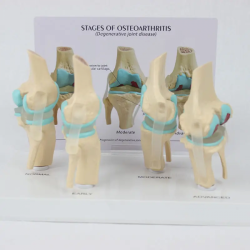 Модель заболевания коленного сустава в натуральную величину 4-этапная анатомическая модель UL-09