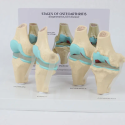 Модель заболевания коленного сустава в натуральную величину 4-этапная анатомическая модель UL-09